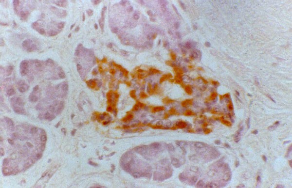 Type I diabetes, islets of Langerhans glucagon secretion