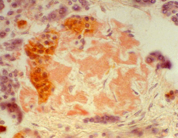 Type II diabetes, amyloid in pancreatic islets