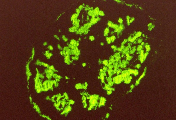 Amyloid deposition in Type II diabetes pancreatic islet