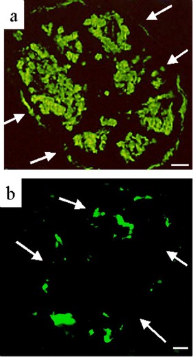 Amyloid deposition in Type II diabetes pancreas islets