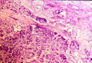 view Focal pancreatitis, inflammation of exocrine cells