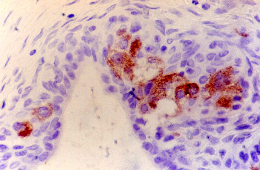 Nesidioblastosis in the neonatal pancreas