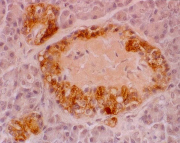 Insulinoma, amyloid deposits in pancreas islets.