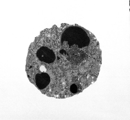 TEM of a cell showing apoptotic bodies