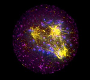 view Human HeLa cancer cell, tripolar mitosis