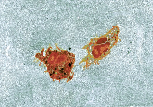 Two granulocytes in the corneal stroma