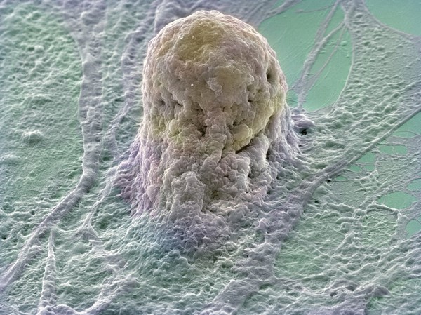 Human embryonic stem cell (gold) growing on a layer of supporting cells (fibroblasts). Stem cells are derived from very early embryos and can either be grown to stay in their original state or triggered to form almost any type of human cell. The fibroblasts provide special factors that maintain the stem cells in their original state. The stem cell appears to be grasped by the underlying fibroblast. Stem cell research could lead to cures for many diseases such as Parkinson's disease, Alzheimer's and diabetes, where a patient's cells are damaged or absent.