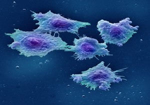 view Human colon cancer cells