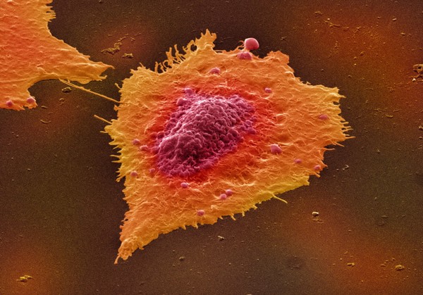 Human colon cancer cells