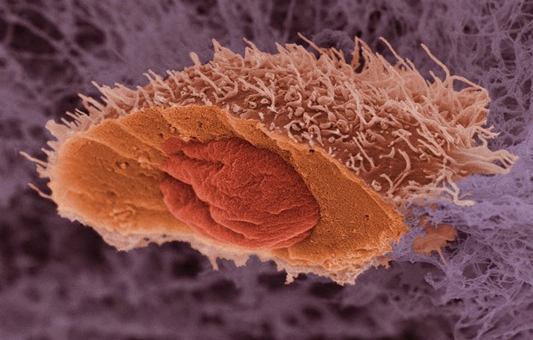 Cell from a squamous cell carcinoma