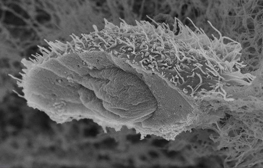 Cell from a squamous cell carcinoma cell line. It has been frozen and split open to reveal its nucleus.