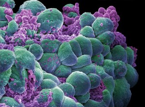 view Breast cancer cells