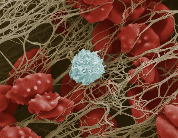Blood clot with crenated red cells