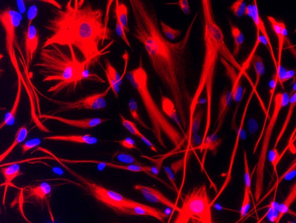 Brain cancer stem cells stained for vimentin (red).