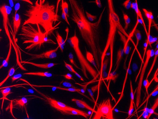 Brain cancer stem cells stained for vimentin (red).