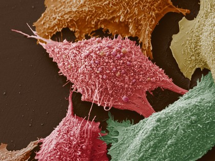 Lung cancer cells