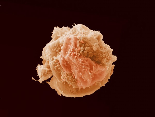 Breast cancer cell