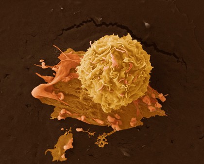 Breast cancer cells