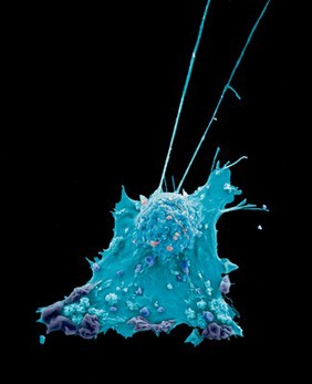 Breast cancer cell