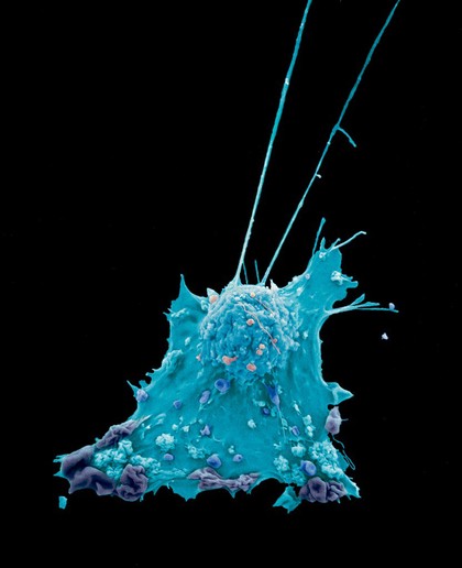 Breast cancer cell