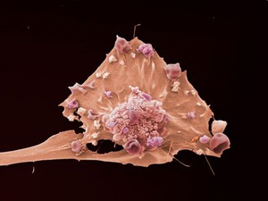 view Breast cancer cell