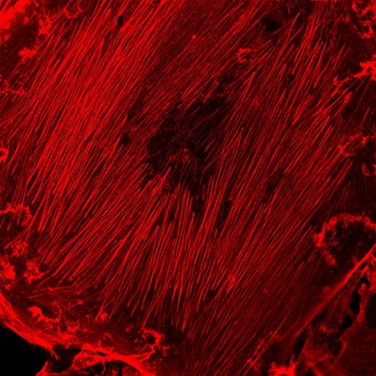 Breast cancer cells