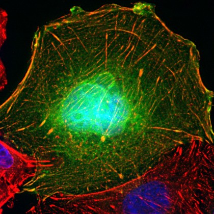 Colon cancer cells