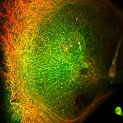 Breast cancer cell