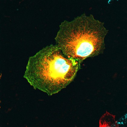 Breast cancer cells