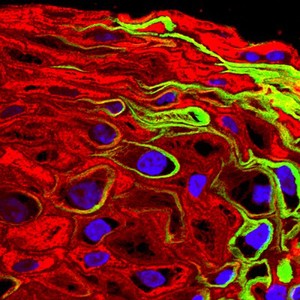 view HPV in cervical epithelium