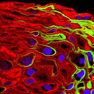 HPV in cervical epithelium