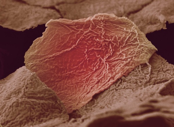 Skin cells from a scald