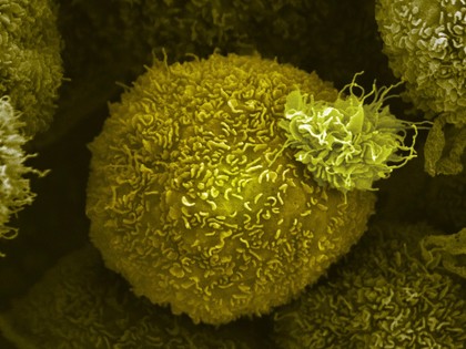 A pancreatic cancer cell.
