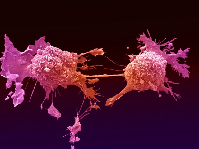 Lung cancer cells