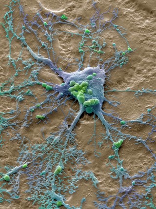 Skin cancer cell