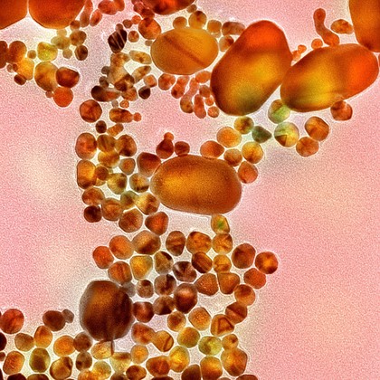 Gold nanoparticles, when coated with a cancer antibody, are effective at binding to tumour cells and can be used in the diagnosis and treatment of cancer. When bound to the gold, the cancer cells scatter light, making it very easy to identify the noncancerous cells from the malignant ones.
