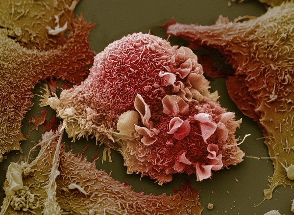Lung cancer cells.