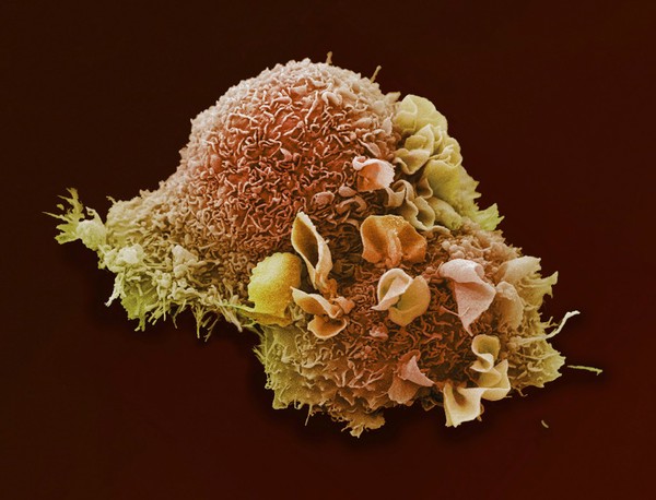 Lung cancer cell.