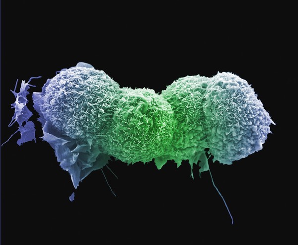 Lung cancer cells.