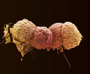 view Lung cancer cells.