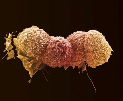 Lung cancer cells.