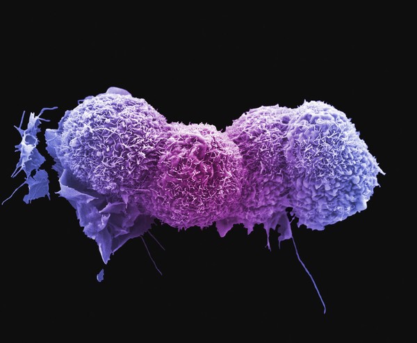 Lung cancer cells.