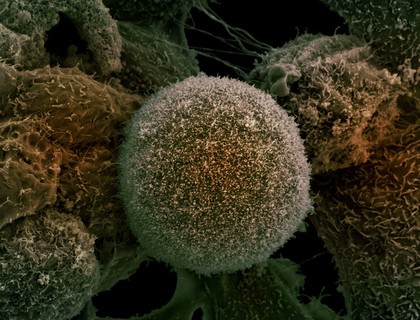 Prostate cancer cells