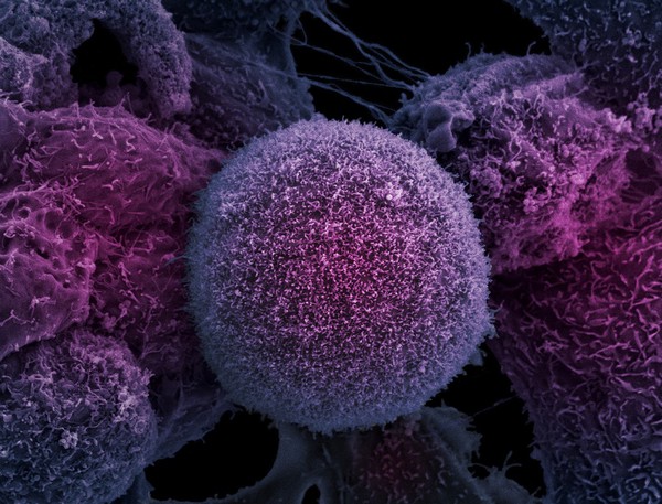 Prostate cancer cells