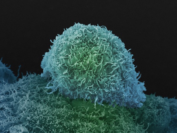 Prostate cancer cell