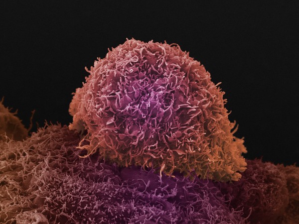 Prostate cancer cell