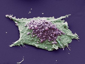 view Lung cancer cell. This image shows a single cell grown from a culture of lung epithelial carcinoma (cancer) cells. The purple area shows blebbing.