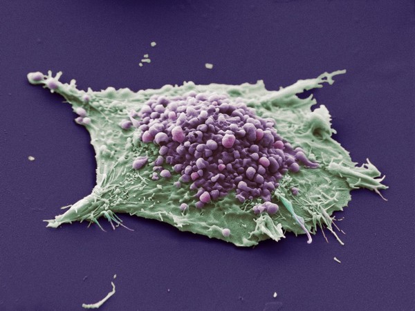 Lung cancer cell. This image shows a single cell grown from a culture of lung epithelial carcinoma (cancer) cells. The purple area shows blebbing.