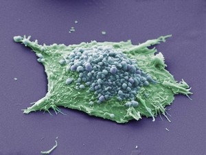 view Lung cancer cell.