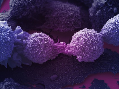 Lung cancer cells.